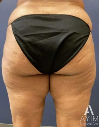 Thigh Lift: Before & After Photos