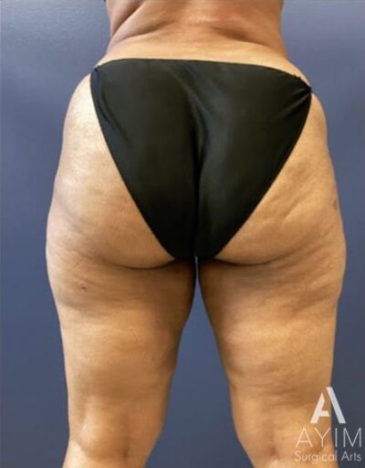 Thigh Lift: Before & After Photos