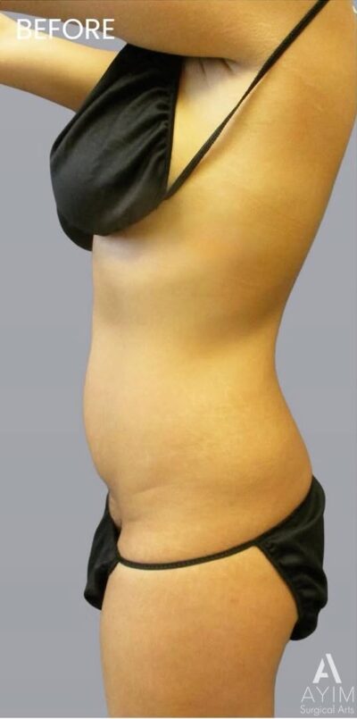 TriSculpt: Before & After Photos