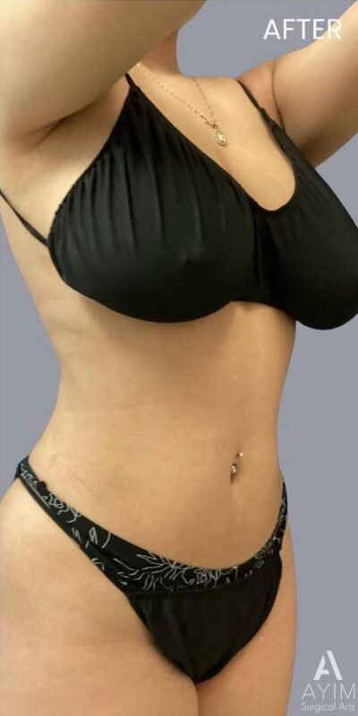 TriSculpt: Before & After Photos