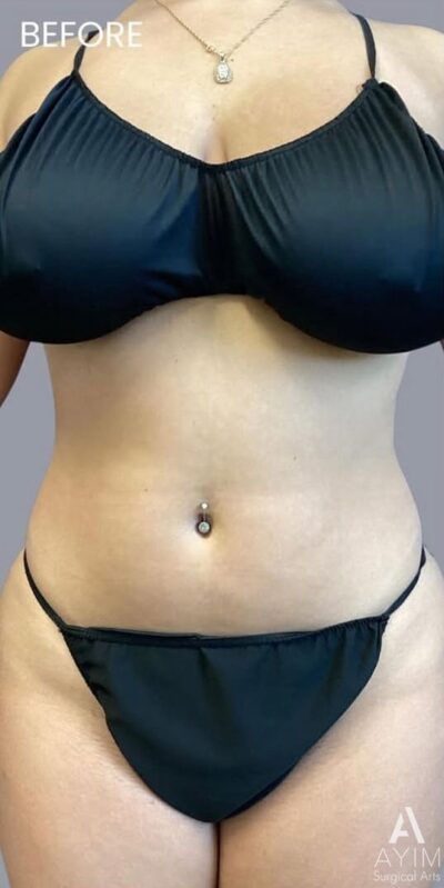 TriSculpt: Before & After Photos
