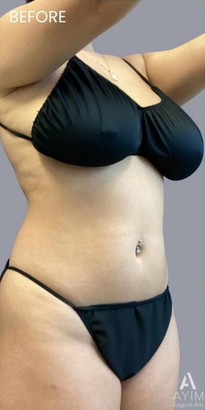 TriSculpt: Before & After Photos