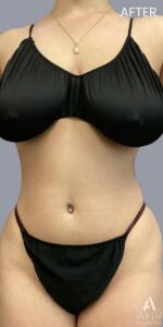 TriSculpt: Before & After Photos
