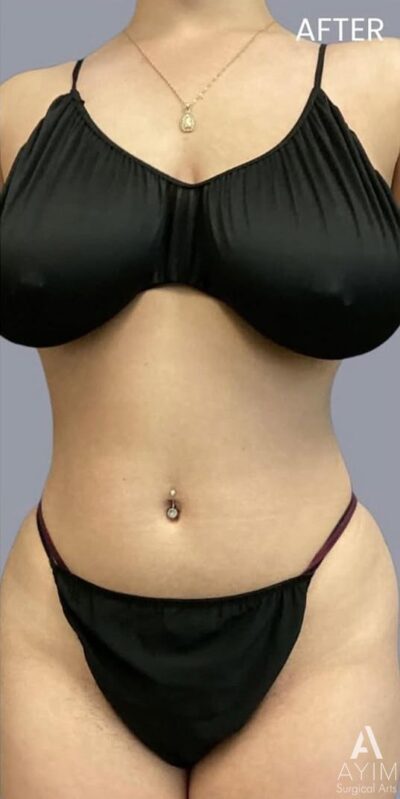 TriSculpt: Before & After Photos