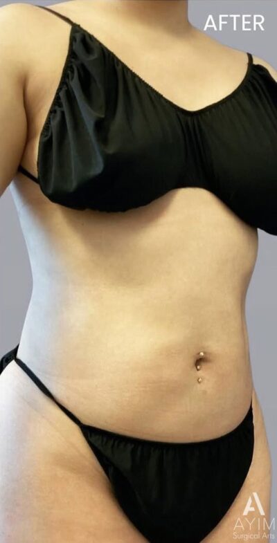 TriSculpt: Before & After Photos