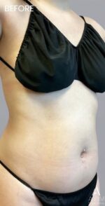 TriSculpt: Before & After Photos