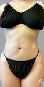 TriSculpt: Before & After Photos