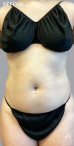 TriSculpt: Before & After Photos