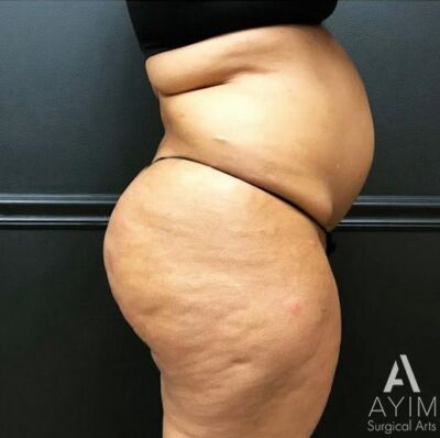 Bodytite: Before & After Photos