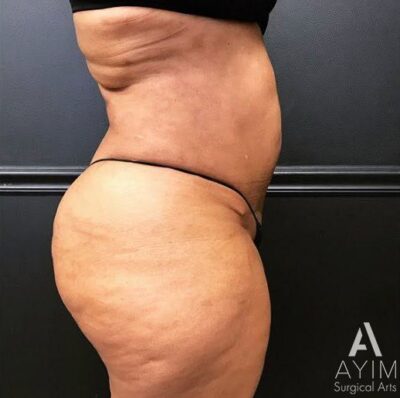 Bodytite: Before & After Photos