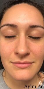 Dermal Filler: Before & After Photos