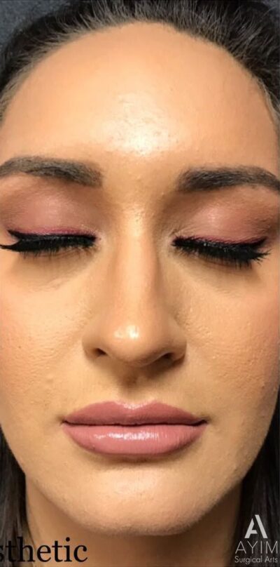 Dermal Filler: Before & After Photos