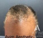 PRP Treatment: Before & After Photos