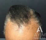 PRP Treatment: Before & After Photos