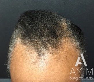 PRP Treatment: Before & After Photos