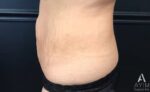 Bodytite: Before & After Photos