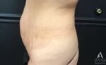 Bodytite: Before & After Photos