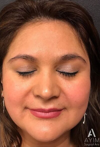 Dermal Filler: Before & After Photos