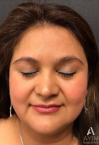 Dermal Filler: Before & After Photos