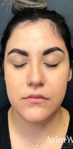 Dermal Filler: Before & After Photos