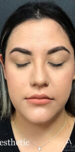 Dermal Filler: Before & After Photos