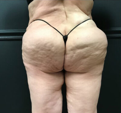 Bodytite: Before & After Photos