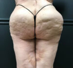 Bodytite: Before & After Photos