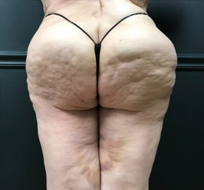 Bodytite: Before & After Photos