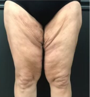 Bodytite: Before & After Photos