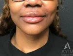 front view after lip augmentation