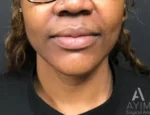 front view before lip augmentation