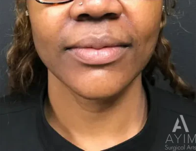 Lip Augmentation: Before & After Photos