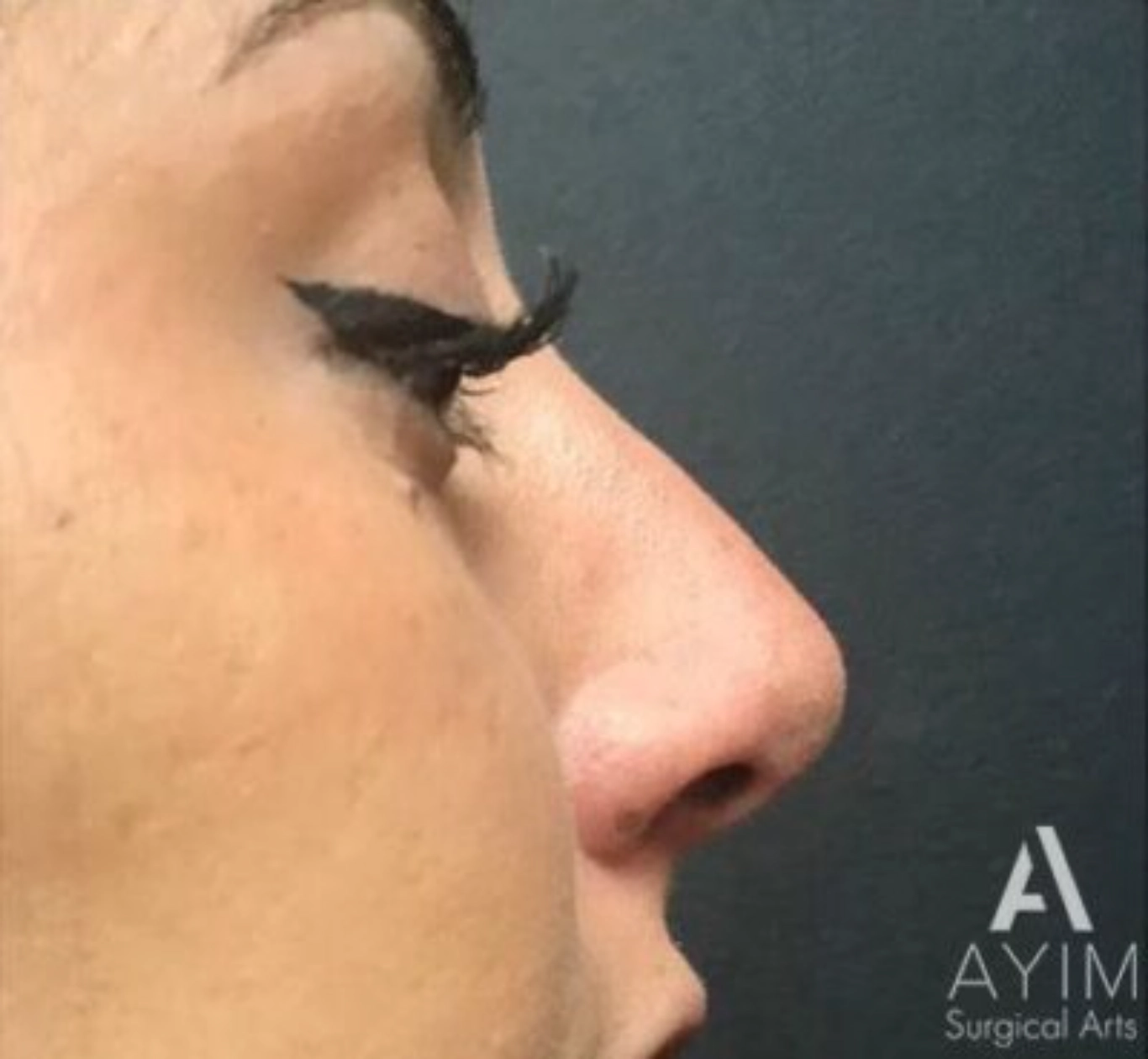 Non-Surgical Rhinoplasty: Before & After Photos Case 11211 After Photo Non-Surgical Rhinoplasty: Before & After Photos