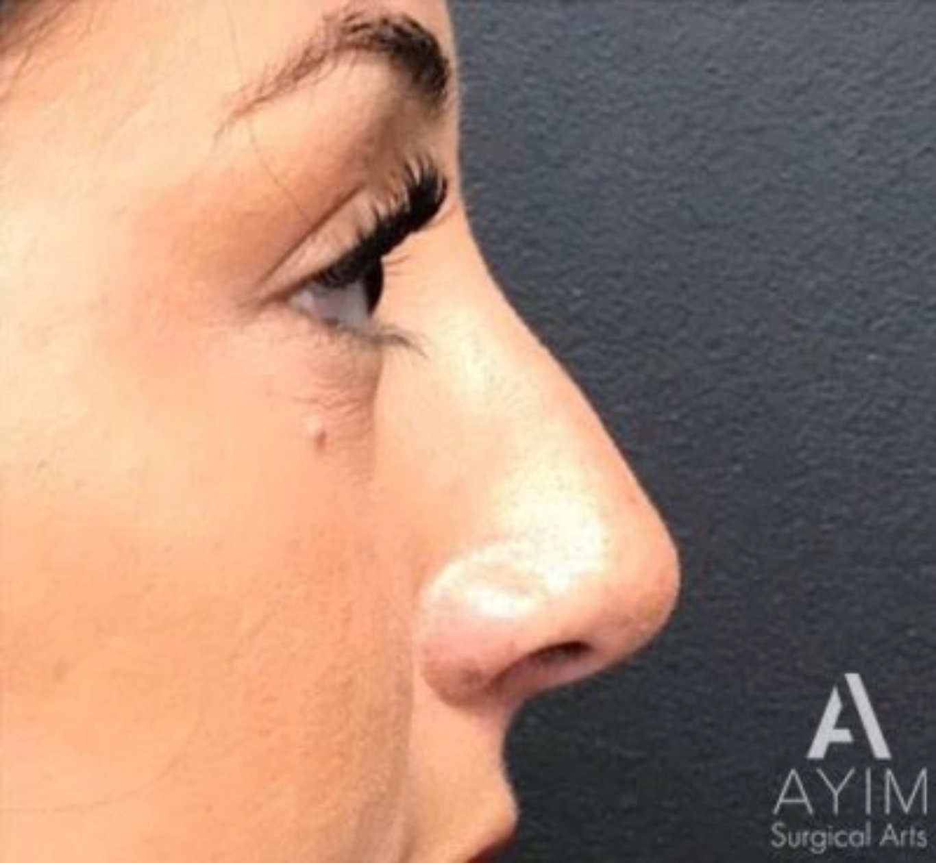 Non-Surgical Rhinoplasty: Before & After Photos Case 11211 Before Photo Non-Surgical Rhinoplasty: Before & After Photos