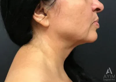 Facetite: Before & After Photos