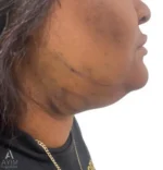 right side view after face liposuction