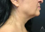 right side view before facetite