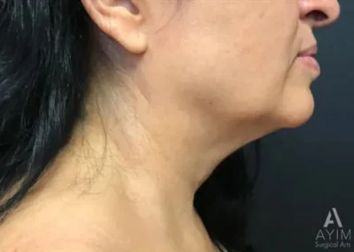 Facetite: Before & After Photos