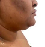 right side view before face liposuction