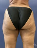 back view after inner thigh bodytite