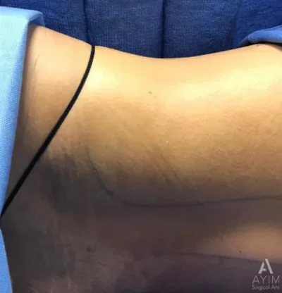 Bodytite: Before & After Photos