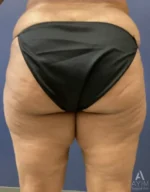 back view before inner thigh bodytite